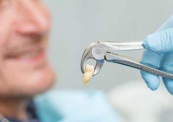 روش های جراحی دندان عقل | بهترین ایمپلنت اصفهان | دکتر ندا مکانیک