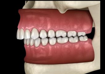 بهترین ایمپلنت اصفهان | بهترین دندانپزشک زیبایی اصفهان | روش های درمان اوربایت | بهترین دندانپزشک کودکان اصفهان | دکتر ندا مکانیک
