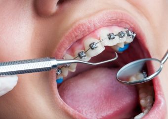 عصب کشی دندان پیش از ارتودنسی | بهترین دندانپزشک کودکان اصفهان | دکتر ندا مکانیک