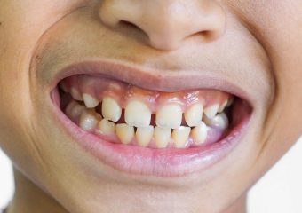 علل ایجاد فاصله بین دندان شیری | بهترین دندانپزشک کودکان اصفهان | دکتر ندا مکانیک