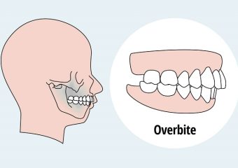 مراحل تشخیص اوربایت در دندانپزشکی | بهترین دندانپزشک زیبایی اصفهان | دکتر ندا مکانیک