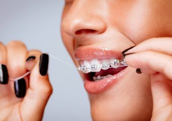 بهترین ایمپلنت اصفهان | بهترین دندانپزشک زیبایی اصفهان | نحوه صحیح نخ دندان کشیدن با ارتودنسی | بهترین دندانپزشک کودکان اصفهان | دکتر ندا مکانیک