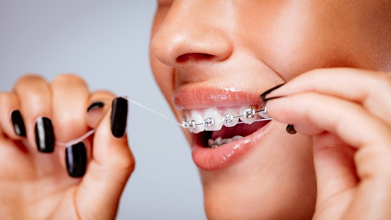 نحوه صحیح نخ دندان کشیدن با ارتودنسی | بهترین دندانپزشک کودکان اصفهان | دکتر ندا مکانیک
