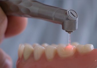 بهترین ایمپلنت اصفهان | بهترین دندانپزشک زیبایی اصفهان | نکاتی در مورد عصب کشی دندان با لیزر | بهترین دندانپزشک کودکان اصفهان | دکتر ندا مکانیک