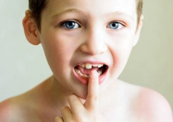 بهترین ایمپلنت اصفهان | بهترین دندانپزشک زیبایی اصفهان | انواع شکستگی دندان در کودکان | بهترین دندانپزشک کودکان اصفهان | دکتر ندا مکانیک