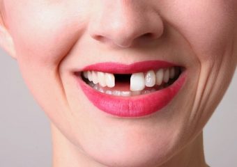 جلوگیری از لق شدن و افتادن کامپوزیت دندان | بهترین ایمپلنت اصفهان | دکتر ندا مکانیک