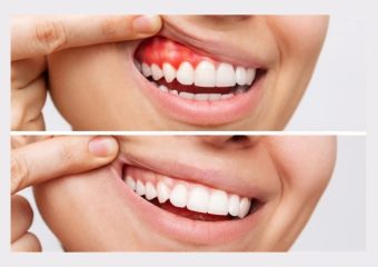 بهترین ایمپلنت اصفهان | بهترین دندانپزشک زیبایی اصفهان | درمان عفونت لثه پس از کامپوزیت دندان | بهترین دندانپزشک اصفهان | دکتر ندا مکانیک