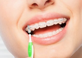 بهترین ایمپلنت اصفهان | روش های تمیز کردن پشت ارتودنسی دندان | بهترین دندانپزشک زیبایی اصفهان | دکتر ندا مکانیک