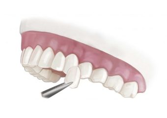 علل شکستن یا افتادن لمینت دندان | بهترین ایمپلنت اصفهان | دکتر ندا مکانیک