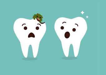 بهترین ایمپلنت اصفهان | بهترین دندانپزشک زیبایی اصفهان | علل و علائم پوسیدگی دندان بعد از کامپوزیت | بهترین دندانپزشک اصفهان | دکتر ندا مکانیک