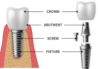مراحل انتخاب فیکسچر برای ایمپلنت دندان | بهترین ایمپلنت اصفهان | دکتر ندا مکانیک