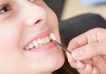 چگونگی درمان شکستن یا افتادن لمینت دندان | بهترین ایمپلنت اصفهان | دکتر ندا مکانیک