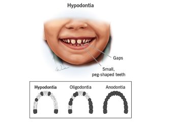 بهترین ایمپلنت اصفهان | آشنایی با فقدان مادرزادی دندان یا هیپودنشیا | بهترین دندانپزشک زیبایی اصفهان | دکتر ندا مکانیک
