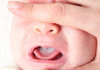 بهترین ایمپلنت اصفهان | روش های درمان برفک دهان کودک | بهترین دندانپزشک زیبایی اصفهان | دکتر ندا مکانیک