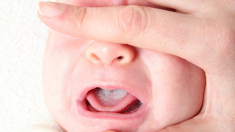 بهترین ایمپلنت اصفهان | روش های درمان برفک دهان کودک | بهترین دندانپزشک زیبایی اصفهان | دکتر ندا مکانیک