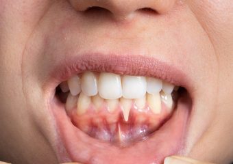 بهترین ایمپلنت اصفهان | بهترین دندانپزشک زیبایی اصفهان | علل و علائم عقب رفتن لثه | بهترین دندانپزشک اصفهان | دکتر ندا مکانیک