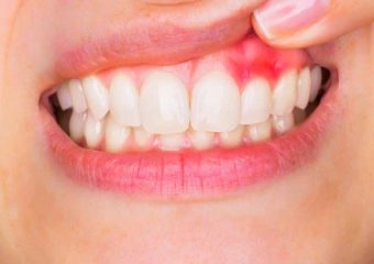 بهترین ایمپلنت اصفهان | بهترین دندانپزشک زیبایی اصفهان | عوارض احتمالی کامپوزیت دندان | بهترین دندانپزشک اصفهان | دکتر ندا مکانیک