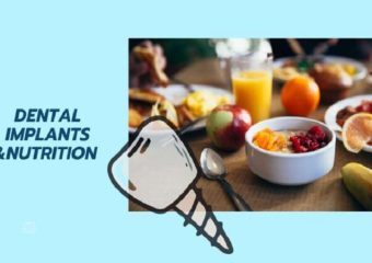 مراقبتهای غذایی پس از جراحی ایمپلنت دندان | بهترین ایمپلنت اصفهان | دکتر ندا مکانیک
