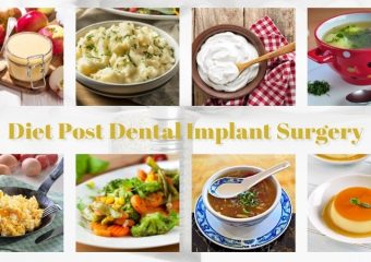 بهترین ایمپلنت اصفهان | نکات تغذیه ای بعد از ایمپلنت دندان | بهترین دندانپزشک زیبایی اصفهان | دکتر ندا مکانیک