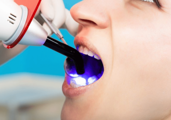 بهترین ایمپلنت اصفهان | ویژگی و مزایای کامپوزیت IPS دندان | بهترین دندانپزشک اصفهان | دکتر ندا مکانیک