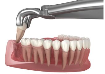 بهترین سن برای کشیدن دندان عقل | بهترین ایمپلنت اصفهان | دکتر ندا مکانیک