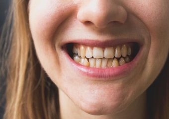 تاثیرات دندان های نامرتب بر سلامت دهان و دندان | بهترین ایمپلنت اصفهان | دکتر ندا مکانیک