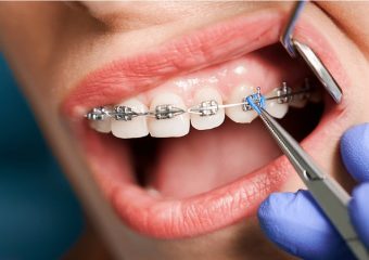 بهترین ایمپلنت اصفهان | بهترین دندانپزشک زیبایی اصفهان | دلایل و علائم پوسیدگی دندان در زمان ارتودنسی | بهترین دندانپزشک اصفهان | دکتر ندا مکانیک