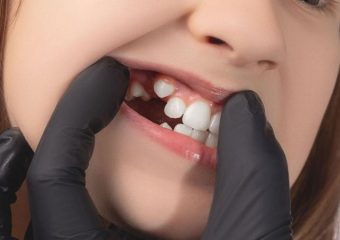 بهترین ایمپلنت اصفهان | بهترین دندانپزشک زیبایی اصفهان | روش های درمان رشد کج دندان دائمی کودک | بهترین دندانپزشک کودکان اصفهان | دکتر ندا مکانیک