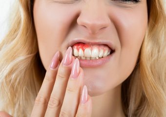 روش های درمان عقب رفتن لثه | بهترین ایمپلنت اصفهان | بهترین دندانپزشک زیبایی اصفهان | دکتر ندا مکانیک