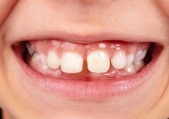 بهترین ایمپلنت اصفهان | بهترین دندانپزشک زیبایی اصفهان | روش های پیشگیری از ایجاد فاصله میان دندان ها | بهترین دندانپزشک کودکان اصفهان | دکتر ندا مکانیک