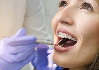 بهترین ایمپلنت اصفهان | بهترین دندانپزشک زیبایی اصفهان | دکتر ندا مکانیک | روش‌های کاهش کشیدن دندان در ارتودنسی | بهترین دندانپزشک اصفهان | دکتر ندا مکانیک