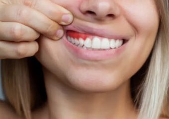 علل و علائم ایجاد حساسیت در لثه |بهترین ایمپلنت اصفهان | بهترین دندانپزشک زیبایی اصفهان | دکتر ندا مکانیک