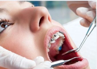 بهترین ایمپلنت اصفهان | بهترین دندانپزشک زیبایی اصفهان | مزایا و معایب کشیدن دندان در زمان ارتودنسی | بهترین دندانپزشک اصفهان | دکتر ندا مکانیک