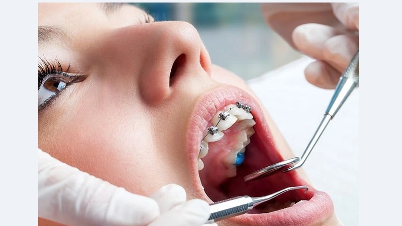 مزایا و معایب کشیدن دندان در زمان ارتودنسی | بهترین دندانپزشک اصفهان | دکتر ندا مکانیک