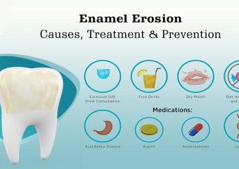 مقابله با روند از بین رفتن مینای دندان | بهترین ایمپلنت اصفهان | دکتر ندا مکانیک