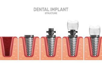 مقایسه ایمپلنت دندان معمولی و فوری | بهترین ایمپلنت اصفهان | بهترین دندانپزشک زیبایی اصفهان | دکتر ندا مکانیک