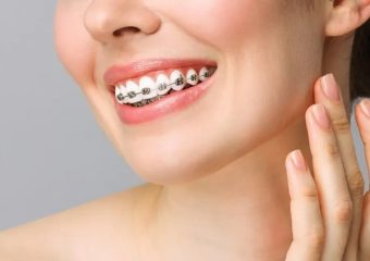 بهترین ایمپلنت اصفهان | بهترین دندانپزشک زیبایی اصفهان | نحوه انجام ارتودنسی در سنین مختلف | بهترین دندانپزشک اصفهان | دکتر ندا مکانیک