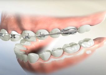 بهترین ایمپلنت اصفهان | بهترین دندانپزشک زیبایی اصفهان | نکاتی در مورد ارتودنسی فک بالا | بهترین دندانپزشک اصفهان | دکتر ندا مکانیک