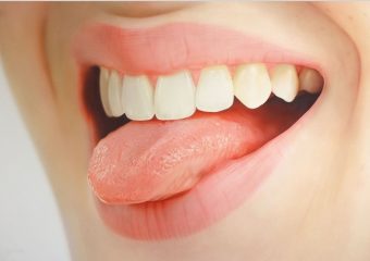 بهترین ایمپلنت اصفهان | بهترین دندانپزشک زیبایی اصفهان | اقدامات مراقبتی بعد از گاز گرفتن زبان و گونه | بهترین دندانپزشک کودکان اصفهان | دکتر ندا مکانیک