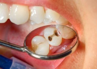 بهترین ایمپلنت اصفهان | بهترین دندانپزشک زیبایی اصفهان | روش ها و مراحل درمان پوسیدگی دندان در ارتودنسی | بهترین دندانپزشک کودکان اصفهان | دکتر ندا مکانیک