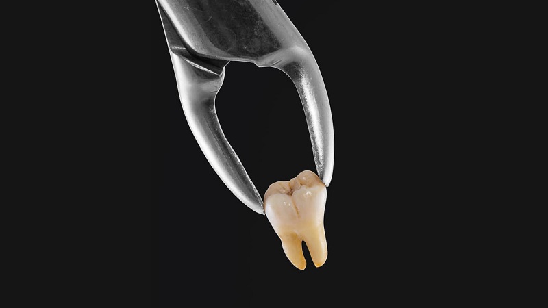 علل نیاز به کشیدن دندان در ارتودنسی | بهترین ایمپلنت اصفهان | بهترین دندانپزشک زیبایی اصفهان | دکتر ندا مکانیک