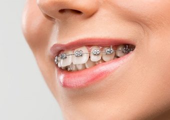 مزایا و عوارض ارتودنسی فک بالا | بهترین ایمپلنت اصفهان | بهترین دندانپزشک زیبایی اصفهان | دکتر ندا مکانیک