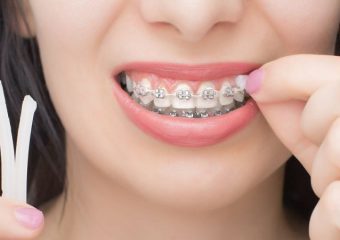 نحوه استفاده و نگهداری از موم ارتودنسی | بهترین ایمپلنت اصفهان | بهترین دندانپزشک زیبایی اصفهان | دکتر ندا مکانیک