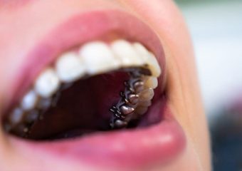 نکات ضروری قبل از ارتودنسی لینگوال | بهترین ایمپلنت اصفهان | دکتر ندا مکانیک