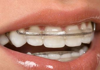 کاربردها و موارد استفاده از ریتینر دندان | بهترین ایمپلنت اصفهان | بهترین دندانپزشک زیبایی اصفهان | دکتر ندا مکانیک