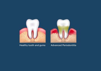 بهترین ایمپلنت اصفهان | بهترین دندانپزشک زیبایی اصفهان | عوامل خطر و راهکارهای پیشگیری از بیماری‌های پریودنتال | بهترین دندانپزشک اصفهان | دکتر ندا مکانیک