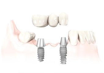 بهترین دندانپزشک زیبایی اصفهان | اثرات عوامل مختلف بر موفقیت و پایداری ایمپلنت‌های دندانی در درازمدت | بهترین ایمپلنت اصفهان | دکتر ندا مکانیک