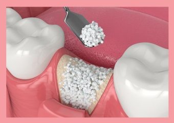 بهترین ایمپلنت اصفهان | بهترین دندانپزشک زیبایی اصفهان | استفاده از سلول‌های بنیادی در بازسازی بافت اطراف ایمپلنت دندان | بهترین ایمپلنت اصفهان | دکتر ندا مکانیک