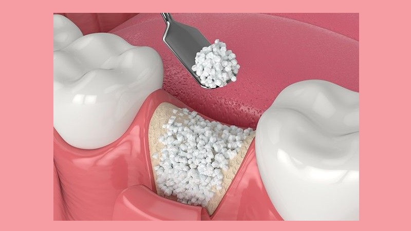 بهترین ایمپلنت اصفهان | بهترین دندانپزشک زیبایی اصفهان | استفاده از سلول‌های بنیادی در بازسازی بافت اطراف ایمپلنت دندان | بهترین ایمپلنت اصفهان | دکتر ندا مکانیک