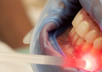 بهترین ایمپلنت اصفهان | استفاده از لیزر در جراحی‌ لثه و سفید کردن دندان‌ها | بهترین دندانپزشک زیبایی اصفهان | دکتر ندا مکانیک